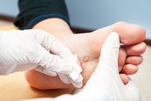 Plantar Warts and Prevention Tips